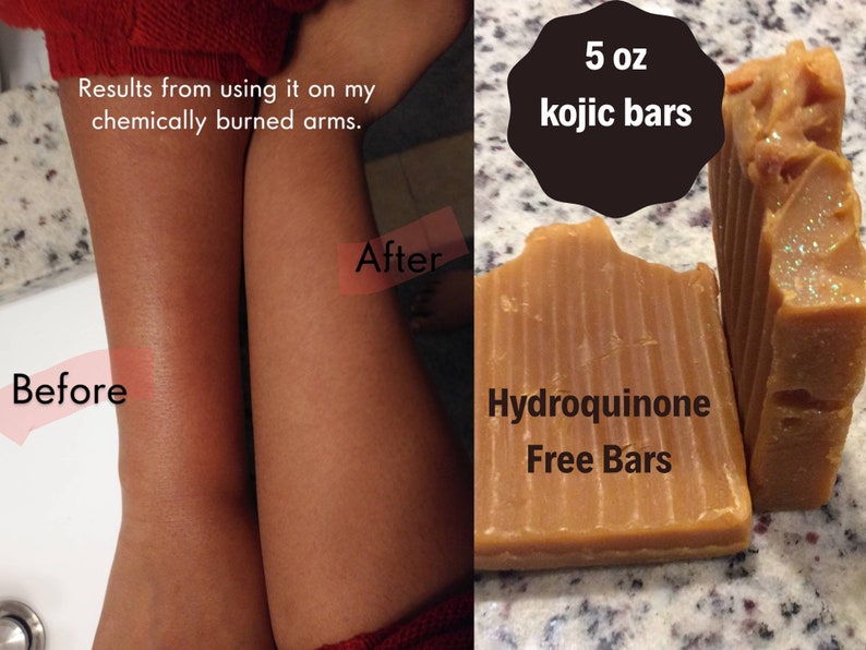 Natural Skin lightening Kojic Acid Soap for hyperpigmentation Etsy