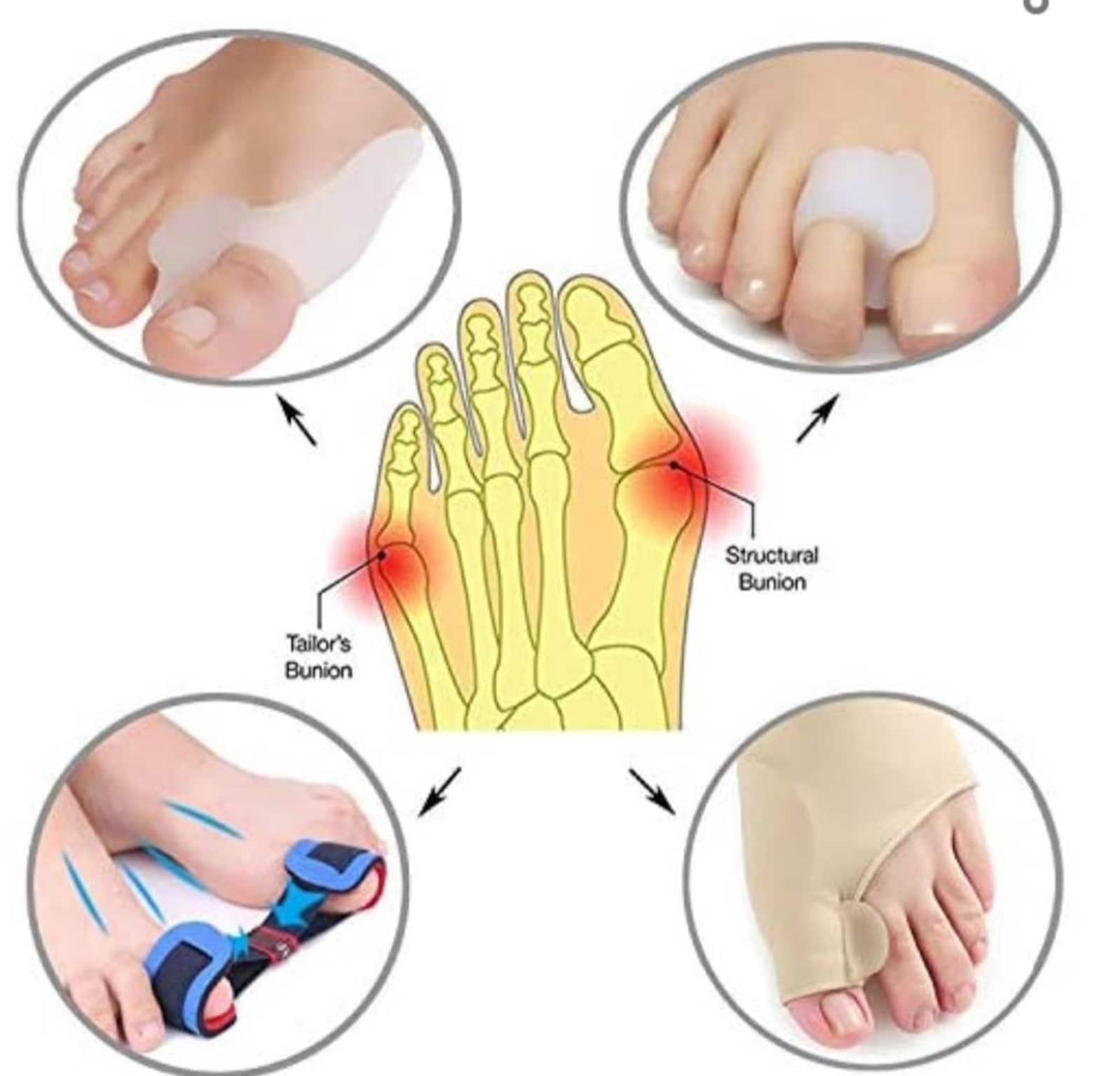 Bunion Corrector & Bunion Relief Protector Sleeves Kit Etsy