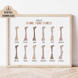 Puede incluir: Una impresión enmarcada titulada "Tipos de fracturas óseas" presenta diagramas ilustrados de diferentes tipos de fracturas óseas. El póster incluye etiquetas como "Hairline", "Avulsed" y "Spiral". La obra de arte está en una paleta de colores neutros.