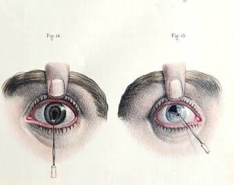 Original lithograph from the 19th century. hand colored - Surgical anatomy - Artificial pupil operations - Ophthalmology, eyes