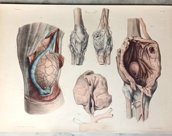 Lithographie originale du XIXe s. colorée à la main - Anatomie pathologique chirurgicale - Divers cas d'anévrismes - Grandeur naturelle