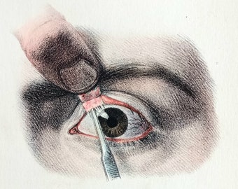 Original lithograph from the 19th century. hand colored - Surgical anatomy - Operations on the eyelids, stye, pannus - Ophthalmology