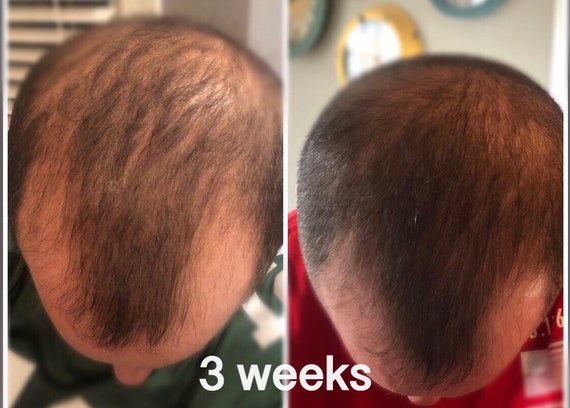 Male Balding Hair Loss Blocker DHT Blocker Caffeine - Etsy Male Balding Hair Loss Blocker DHT Blocker Caffeine - Etsy