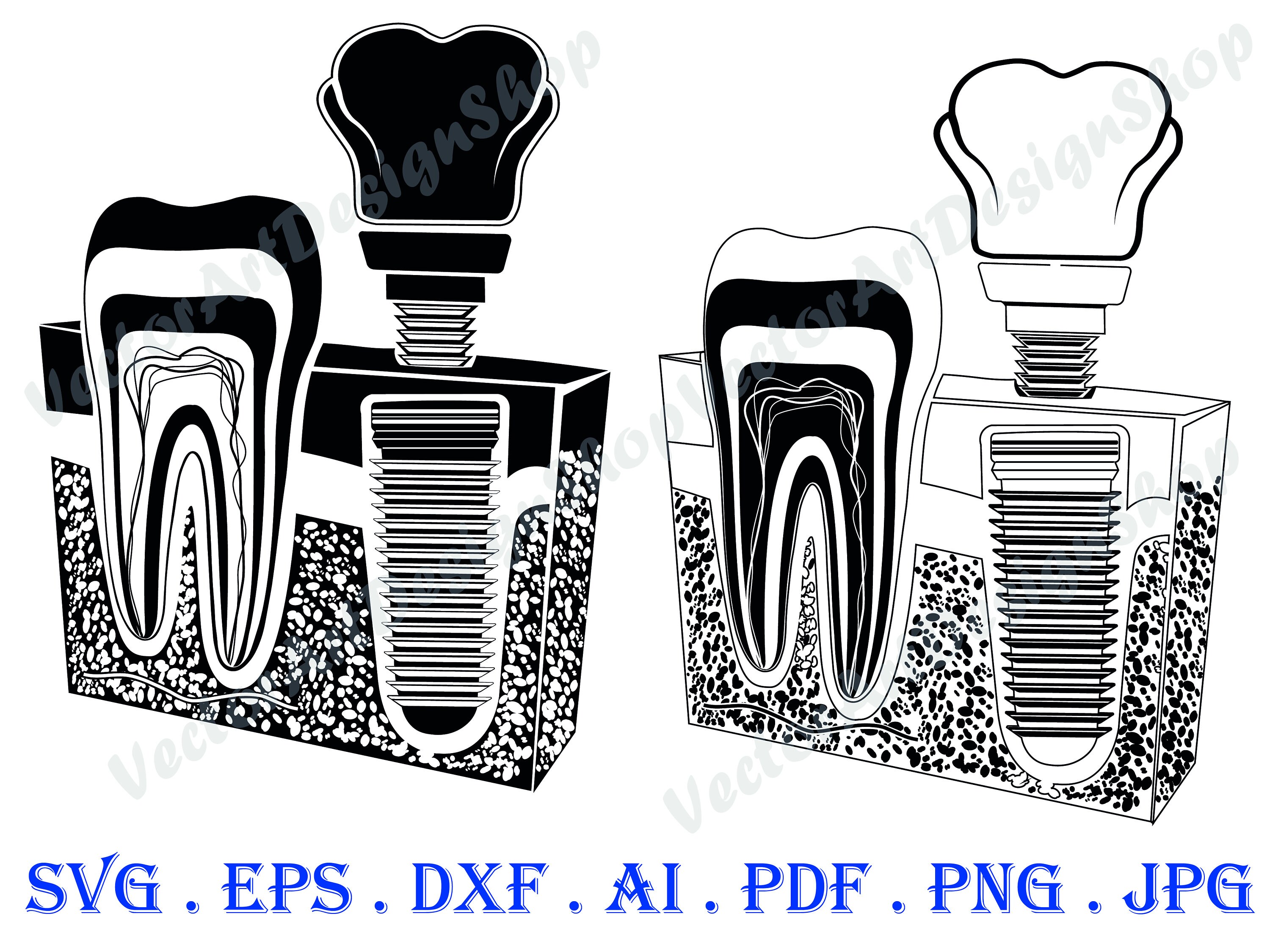 Dental Implant 3 SVG Dentist Svg Tooth Svg Dental Implant Etsy