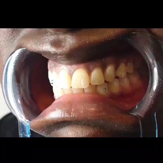 Tooth Gem Videos
