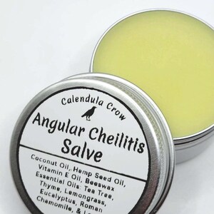 Angular Cheilitis Salve