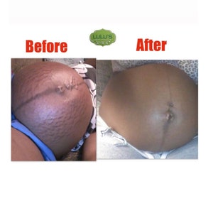 Stretch Mark Remover