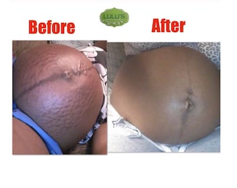 Stretch Mark Remover