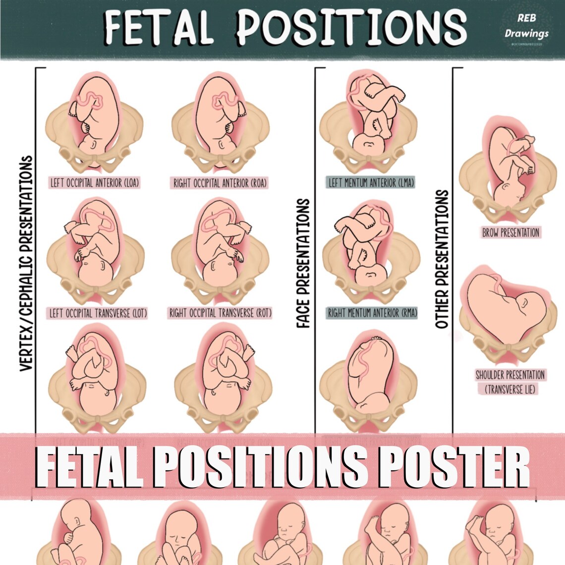 Fetal Postions In The Uterus Poster Etsy Fetal Postions In The Uterus Poster Etsy