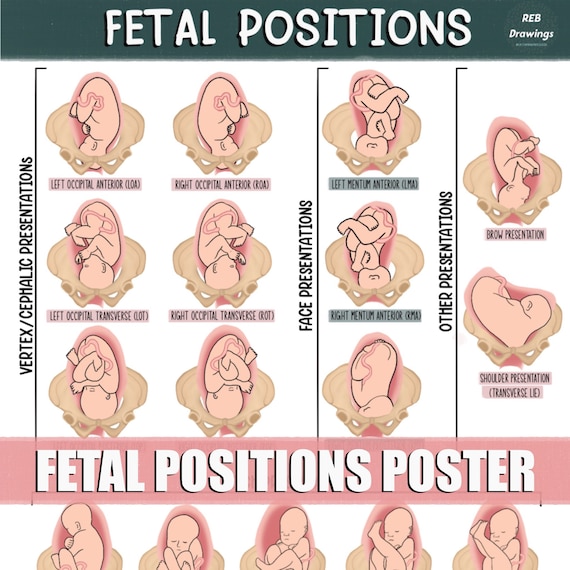 Fetal Postions in the Uterus Poster Etsy