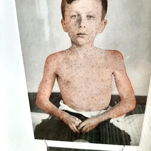 Ilustración médica antigua sobre el sarampión: arte sobre enfermedades infecciosas, rareza en caja de sombras