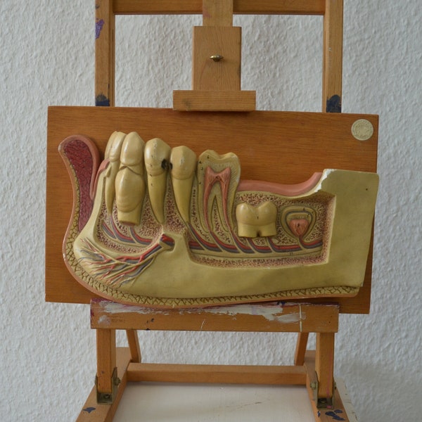 Menschliche Zähne, Zahnzerfall: vintage anatomisches Modell original SOMSO Anatomie 1950er Jahre Deutsche medizinische Ausbildung Zahn karies Kuriosität Zahnarzt