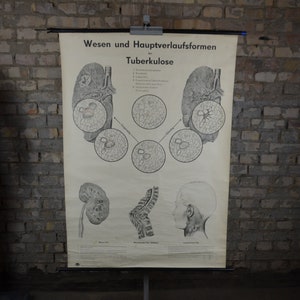 Tuberculosis pulmonar, órganos respiratorios, anatomía humana: cartel educativo alemán vintage original de la década de 1950 gráfico de pared de la escuela anatomía enfermedad