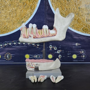 Human Jaw, Teeth, Tooth Decay: large vintage anatomical model original SOMSO 1970s German medical educational dental karies dentist anatomy