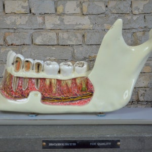Giant Human Jaw, Tooth Decay: vintage anatomical model original dental anatomy 1950s German medical educational dentist huge oddity teeth