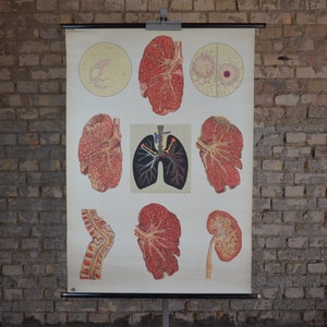 Tuberculosis pulmonar, órganos respiratorios, anatomía humana: original vintage de la década de 1970 póster educativo alemán gráfico de pared de la enfermedad de la anatomía de la escuela
