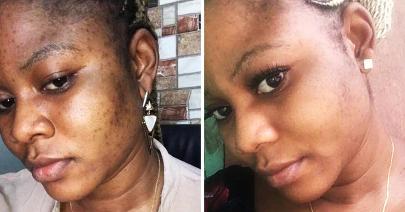 Turmeric Kojic Soap Dark Spot Remover Even Skin Tone Etsy