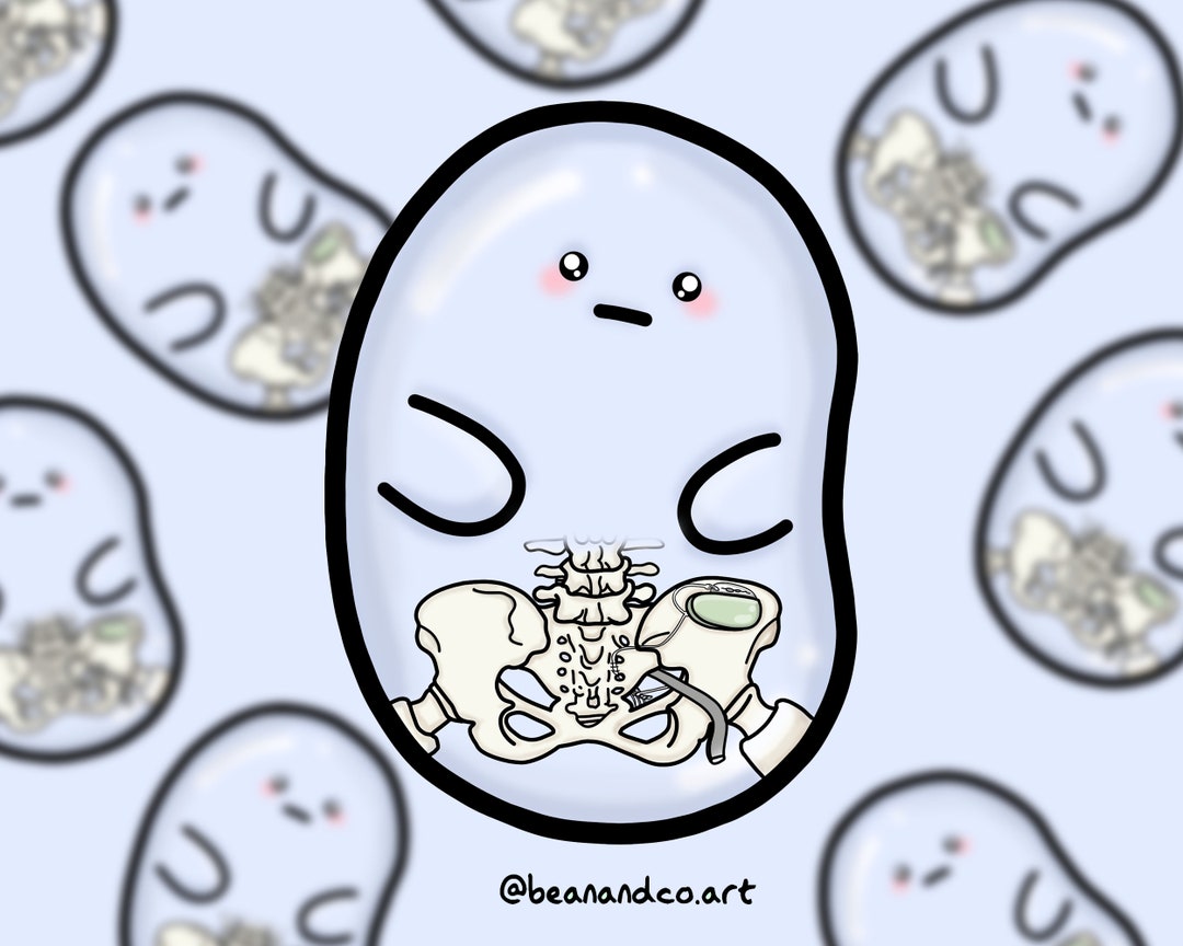 Sacral Nerve Stimulator Bean Sticker- 5cm Gloss Sticker- Bladder/ Bowel ...