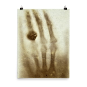 First X-Ray Photo Print: Mrs. Röntgen&#39;s Hand - Wilhelm Röntgen