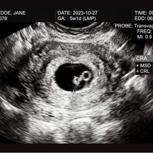 May include: A grayscale ultrasound image showing a developing embryo. The image includes text indicating the patient's name, ID, date, time, and measurements. The embryo is visible within a circular structure, with crosshairs indicating measurements of 10.0 mm and 2.5 mm.