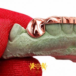 Custom rose gold grillz set showing exposed front teeth framed by a polished top bar and canine caps