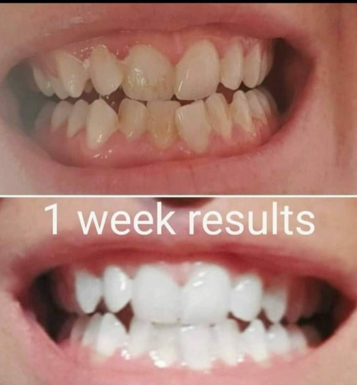 3 In1 Teeth Whitening Foam Fm World Free UK delivery Etsy