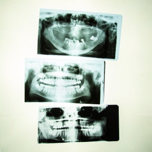 Real Vintage Dental X-Ray Film, X Ray Slides of Teeth