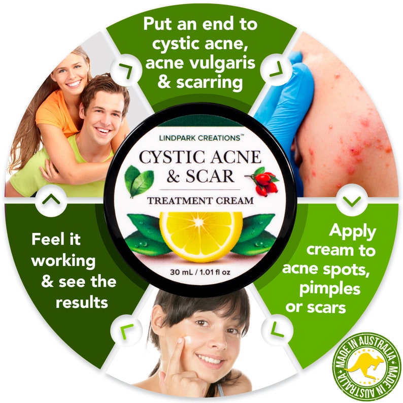 CYSTIC ACNE & SCAR Herbal Cream Pimples, Milia, H.S., Folliculitis