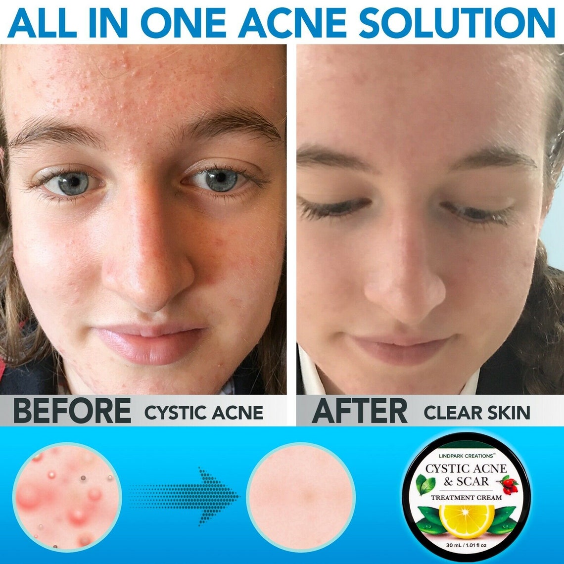 Cystic Acne & Scar Treatment Cream Antibacterial Exfoliation Etsy