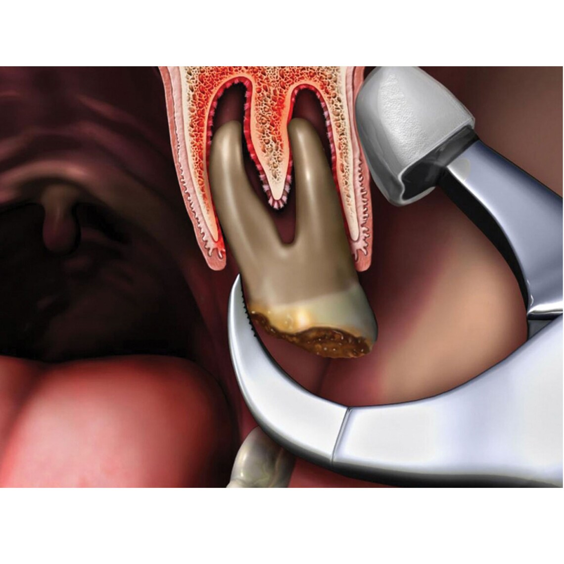 YSCARE Dental Physics Tooth Extraction Pliers Standard Series Etsy