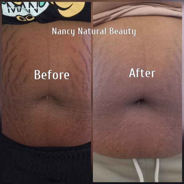 Natural Stretch Mark & Blemish Combo