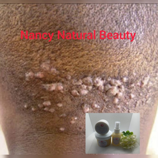 Natural Bump Stopper Cream & Soap | Razor Bumps Stopper