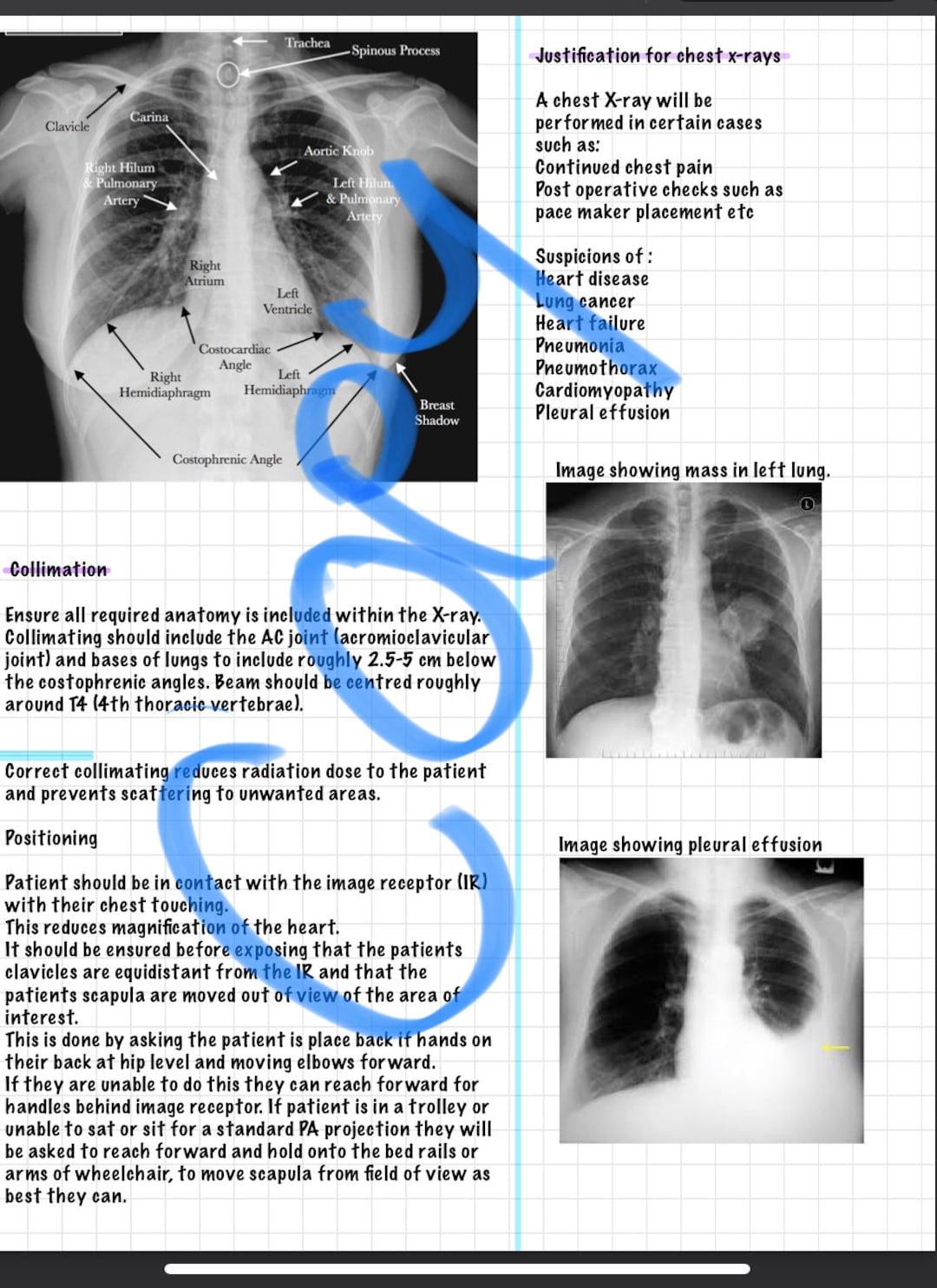 Chest Xray Interpretation and Beginners Anatomy Etsy