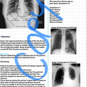 May include: A black and white chest x-ray image showing a mass in the left lung. The image is labeled with anatomical features, including the trachea, clavicle, right hilum, left hilum, right atrium, left ventricle, costocardiac angle, right hemidiaphragm, left hemidiaphragm, and breast shadow. The image also includes text explaining the justification for chest x-rays, including the reasons for performing the procedure and the potential diagnoses.