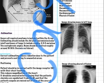 Chest X-ray interpretation and beginners anatomy