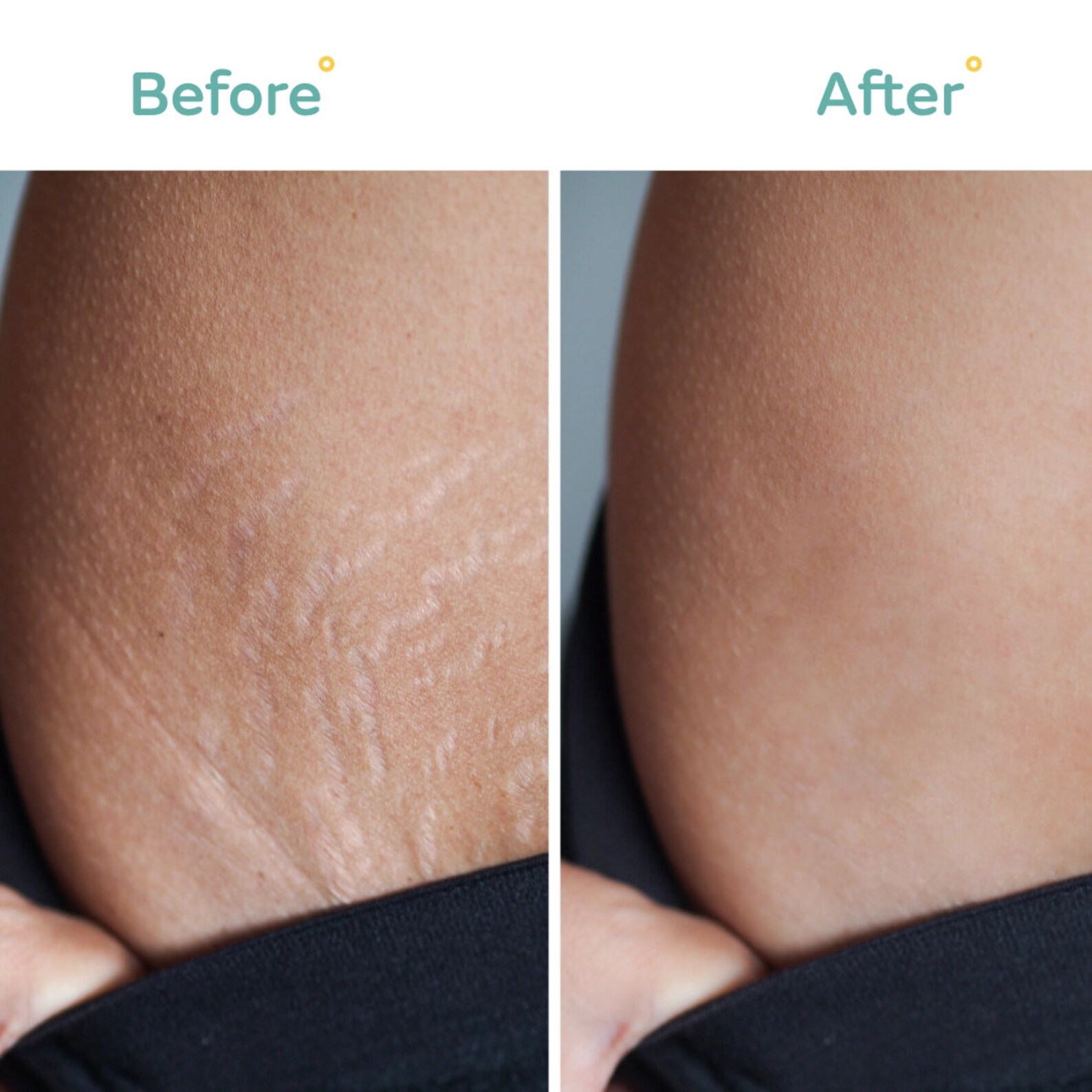 Stretch Mark Oil With Python Oil Scar Remover Oil Stretch - Etsy UK