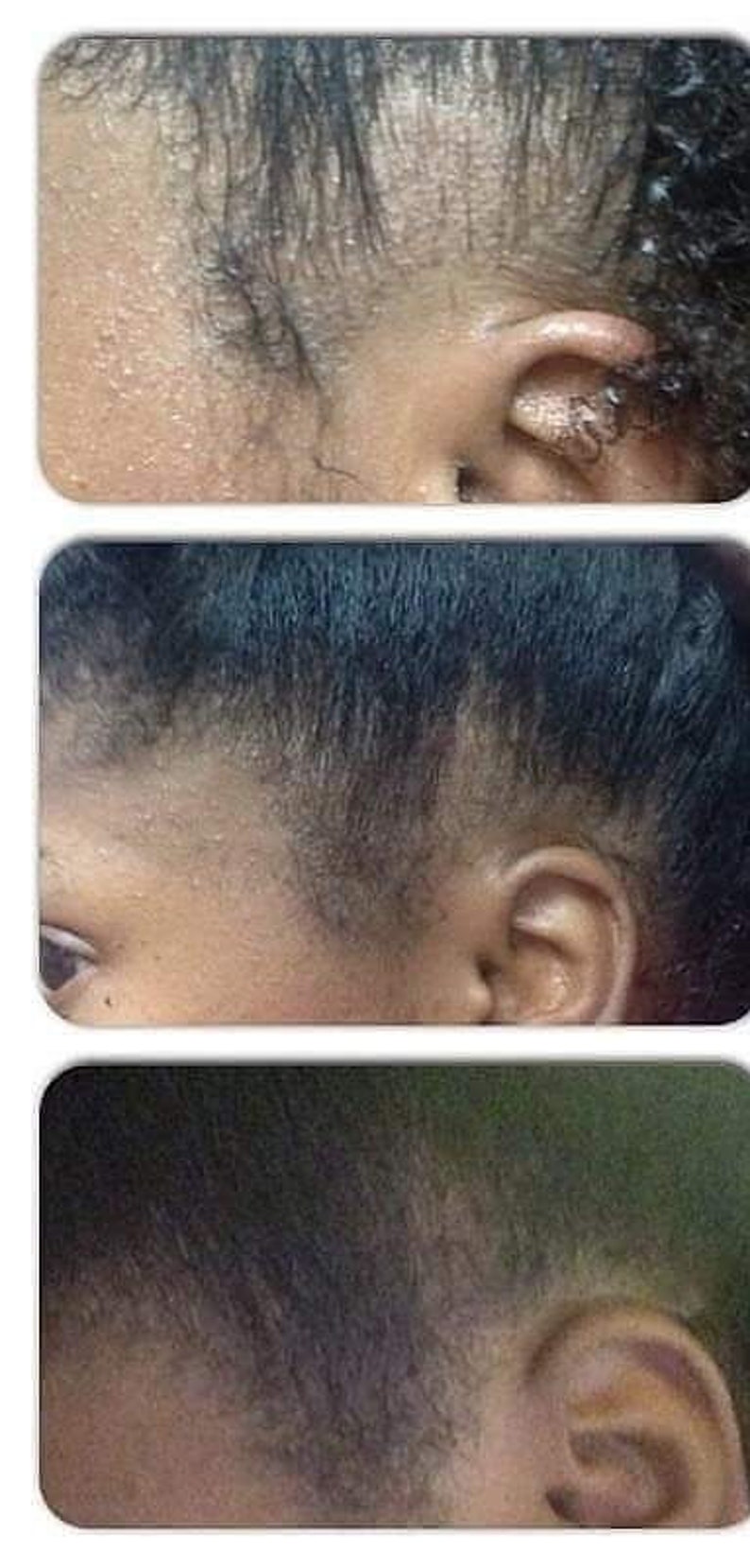 Peppermint blast Bald spots, Damaged edges, Hair growth, Hair loss, Hair Scrum, Stunted Growth, Hair Growth Butter, Thinning hair image 6