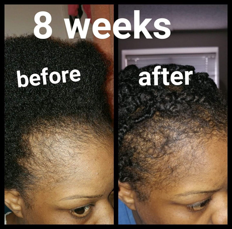 Peppermint blast Bald spots, Damaged edges, Hair growth, Hair loss, Hair Scrum, Stunted Growth, Hair Growth Butter, Thinning hair image 8