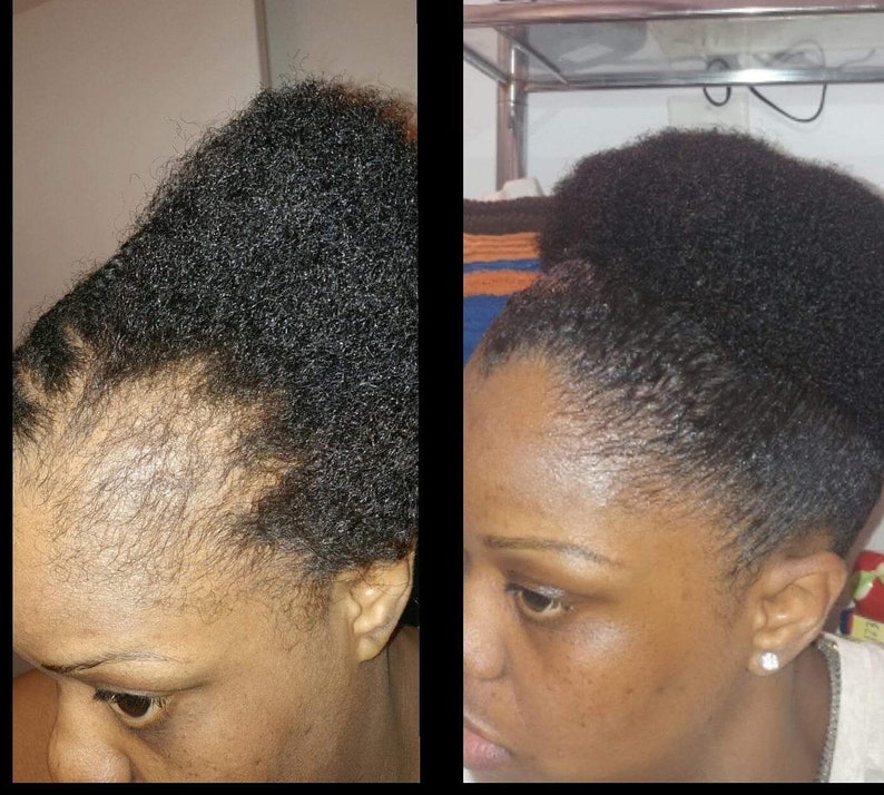 Peppermint blast Bald spots, Damaged edges, Hair growth, Hair loss, Hair Scrum, Stunted Growth, Hair Growth Butter, Thinning hair image 2