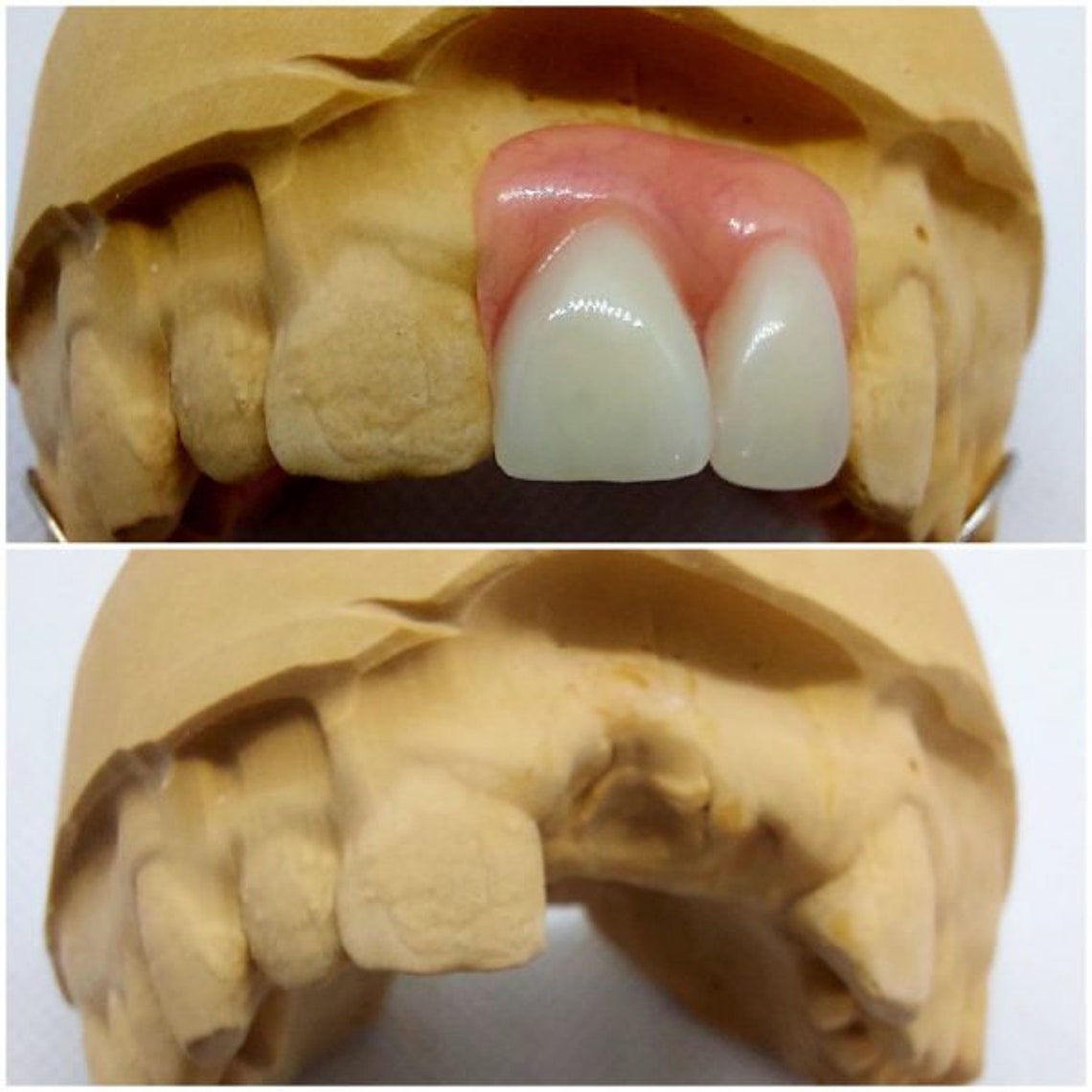 Athome Dental Impression Kit Partial Dentures Flexible Etsy UK