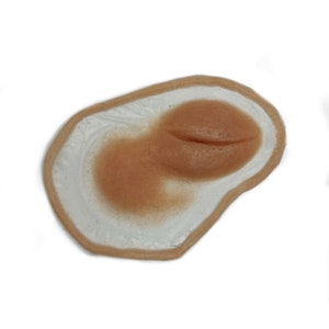 Stark geschwollenes Auge rechts / eingekapselte Silikonprothese / Verletzung /. Trauma / SFX / Moulage / zusammenschlagen