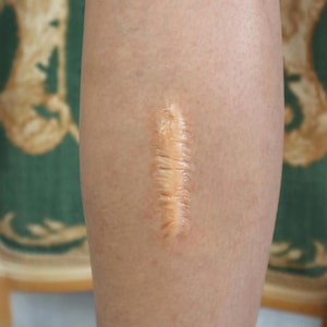 Realistic Keloid Scar Prosthetic 2 x 7 cm | Hulu, Disney, Netflix | 7 Skin Tones | Scar Prosthetic | SFX Makeup Film TV Halloween