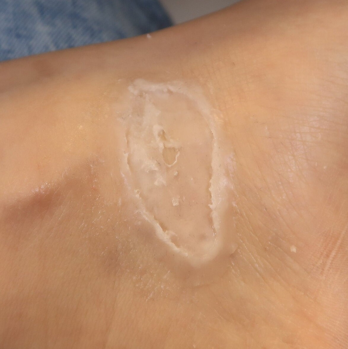 Open Wound / Ulcer Silicone Prosthetic SFX Makeup Film / TV Etsy