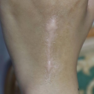 Può includere: Primo piano della pelle con una cicatrice visibile. La cicatrice, di colore più chiaro, si estende verticalmente. La pelle appare liscia con una certa consistenza.