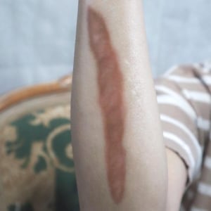 May include: Close-up of an arm with a prominent, reddish-brown scar. The scar is long and linear, contrasting against the lighter skin tone. The background is blurred, with hints of a patterned chair and clothing.