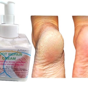 FOOT REPAIR CREAM- for Dry Cracked Feet, Athletes Foot, Nail Fungus, Jock Itch, Ringworm, Cracked Heels and Itchy Skin