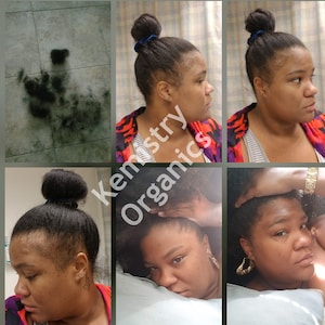 before and after postpartum hair loss growth results shedding thinning hair loss