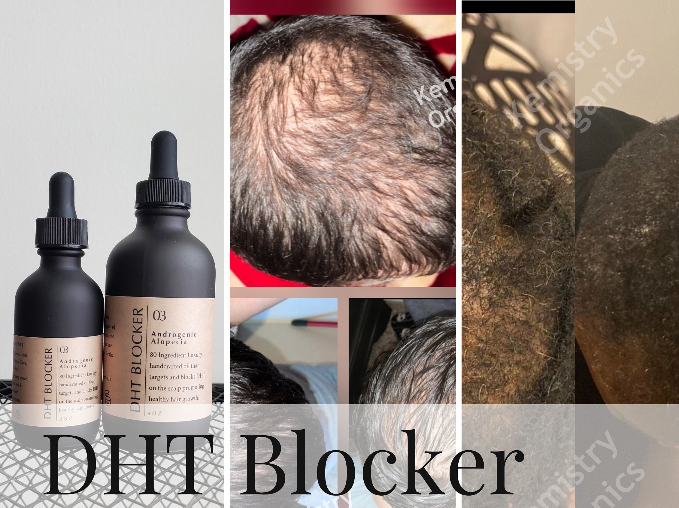 Foods That Block DHT and Fight Hair Loss  How Can I Reduce DHT Naturally  Dr Anil Garg  YouTube