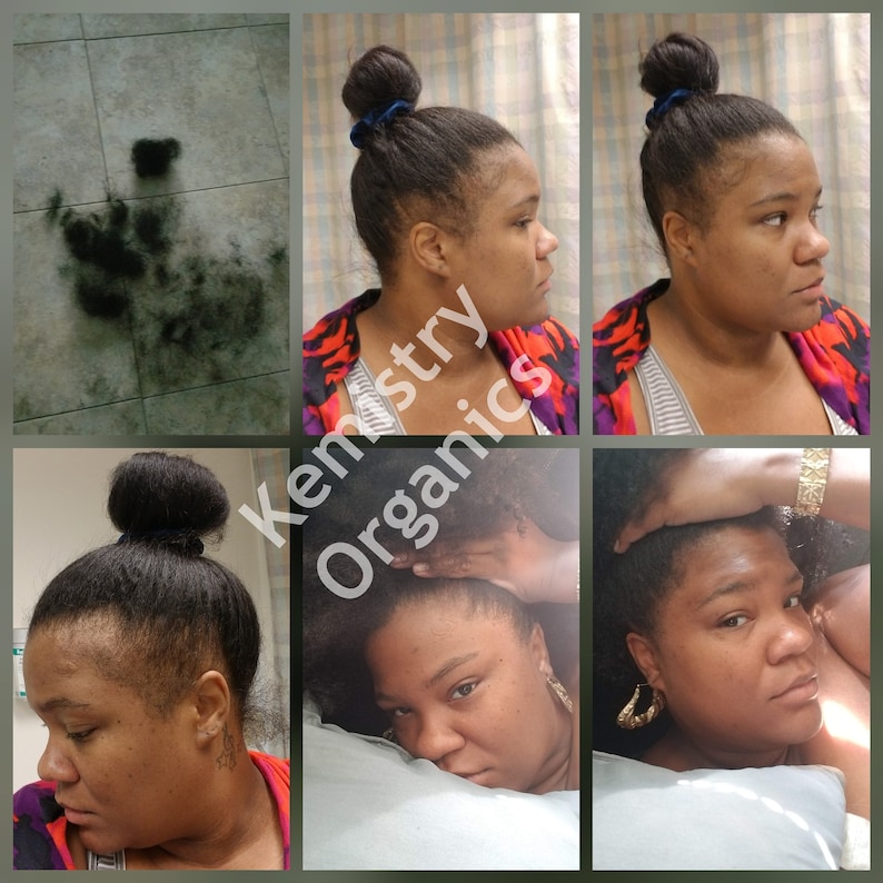 before and after postpartum hair loss growth results shedding thinning hair loss