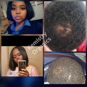before and after bald spots dht alopecia